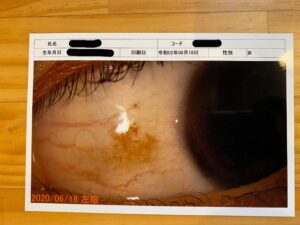 きくな湯田眼科　結膜母斑の除去　体験談　経過　写真